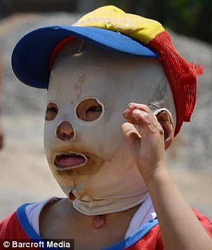 Cậu bé bị mất bốn ngón tay và mắt phải không còn nhìn được sau đám cháy kinh hoàng vào tháng 10 năm 2010.