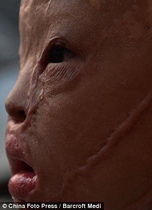 Cận cảnh gương mặt biến dạng đáng thương của cậu bé.