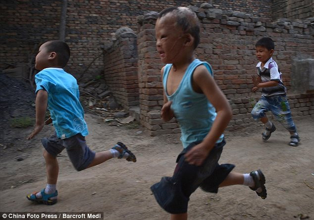 Sau vài tháng điều trị gương mặt cậu đã thay đổi nhiều. Tuy nhiên, cậu sẽ còn phải tiến hành nhiều cuộc phẫu thuật để khôi phục lại một số đặc điểm trên gương mặt.