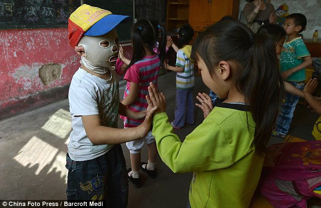 Từng bị bạn bè xa lánh và gọi là "quái vật", nhưng nay cậu bé đã phần nào quay trở lại cuộc sống bình thường.