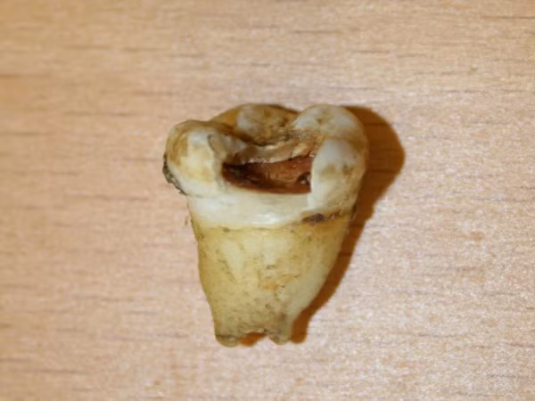 Răng của huyền thoại Beatles John Lenon được bán đấu giá tháng 11/2011. Tuy đã bị đổi màu và hư hỏng nặng, nhưng giá bán của nó cũng lên tới 31.000 USD.