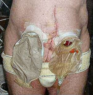 Một bệnh nhân phải phẫu thuật vì ung thư ruột già Một bệnh nhân phải phẫu thuật vì ung thư ruột già