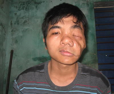 Anh Võ Tiến bị biến dạng khuôn mặt vì các khối u