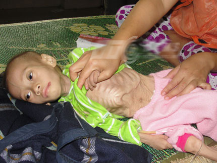 Cháu Hứa Văn Dũng lúc mới nhập viện Huyết học và truyền máu TW. Cháu Hứa Văn Dũng lúc mới nhập viện Huyết học và truyền máu TW.