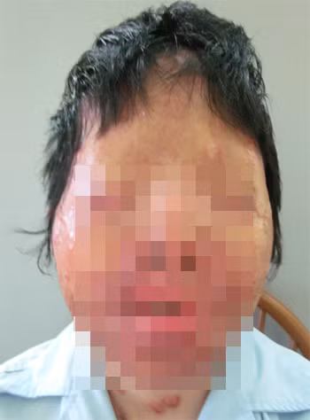 Chị Thúy trước khi phẫu thuật với khuôn mặt bị phá hủy toàn bộ. Ảnh: Bệnh viện.