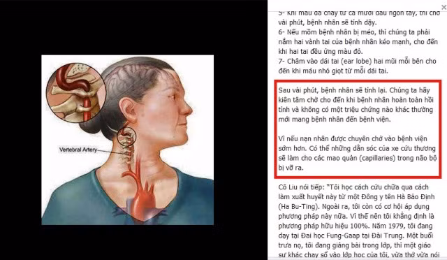Bài viết trên Facebook đã nhận hàng ngàn cảm ơn và chia sẻ nhưng lại là một tư vấn sai lầm về cách cấp cứu nạn nhân bị tai biến.