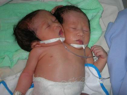 Bé gái 2 đầu ở Sóc Trăng. Ảnh: Thiên Phước. Bé gái 2 đầu ở Sóc Trăng. Ảnh: Thiên Phước.