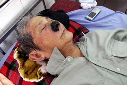 Trên 120 con dòi đã được gắp ra từ mũi ông Tự. Trên 120 con dòi đã được gắp ra từ mũi ông Tự.