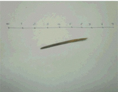 Chiếc tăm tre là thủ phạm đâm thủng ruột ông T Chiếc tăm tre là thủ phạm đâm thủng ruột ông T