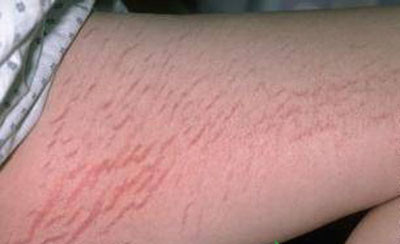 Rạn da ở tuổi dậy thì. Ảnh: SKDS. Rạn da ở tuổi dậy thì. Ảnh: SKDS.