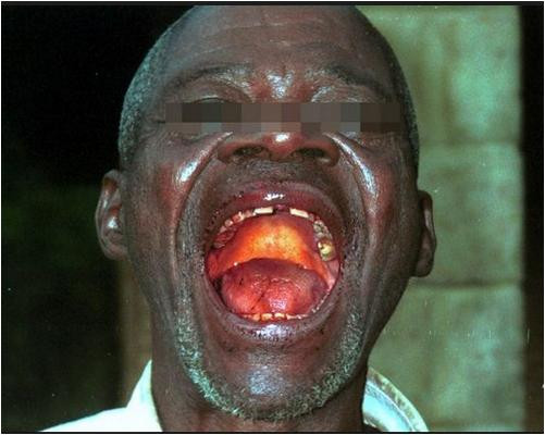 Một nạn nhân nhiễm Ebola Một nạn nhân nhiễm Ebola