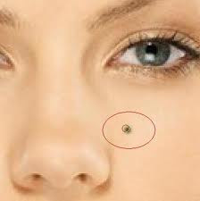 Dù chỉ là cái nốt ruồi nhỏ xíu, vợ đại gia cũng không tiếc tiền để tẩy nó ở trời Tây