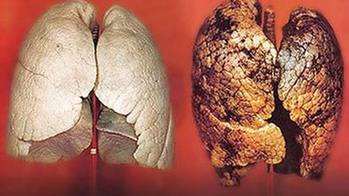 Ung thư phổi và gan được đánh giá là 2 trong 10 loại ung thư phổ biến nhất khu vực Đông Nam Á cũng như tại Việt Nam. Ảnh minh họa, nguồn: Internet. Ung thư phổi và gan được đánh giá là 2 trong 10 loại ung thư phổ biến nhất khu vực Đông Nam Á cũng như tại Việt Nam. Ảnh minh họa, nguồn: Internet.