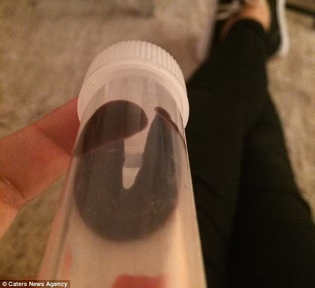 Con đỉa đã làm tổ trong mũi Daniela Liverani