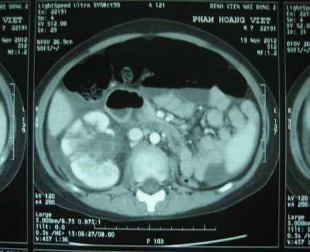 Hình ảnh siêu âm cho thấy bé Việt chỉ có 1 quả thận Hình ảnh siêu âm cho thấy bé Việt chỉ có 1 quả thận