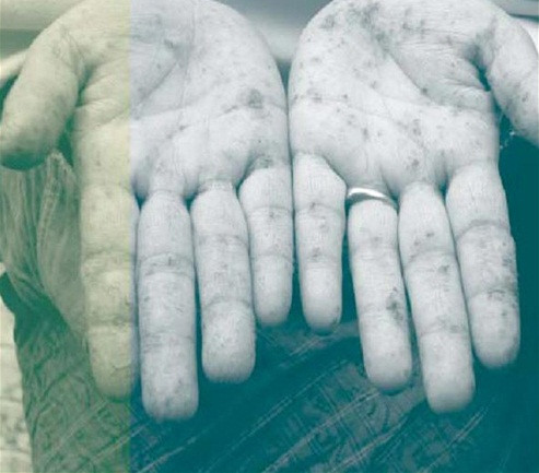 Triệu chứng bị sừng hóa và vết sám tay khi nhiễm Asen lâu ngày. Triệu chứng bị sừng hóa và vết sám tay khi nhiễm Asen lâu ngày.