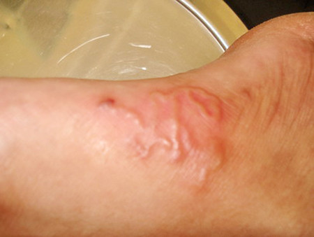 Bệnh nhân bị nhiễm giun lươn. Bệnh nhân bị nhiễm giun lươn.