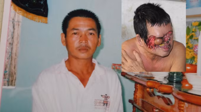 Ông Nguyễn Tấn Sĩ trước và sau khi tẩy nốt ruồi trên hốc mũi - Ảnh: N.HẬU Ông Nguyễn Tấn Sĩ trước và sau khi tẩy nốt ruồi trên hốc mũi - Ảnh: N.HẬU