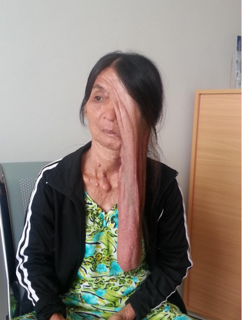 Khối u khổng lồ đeo đẳng chị Tuyết hơn 50 năm qua.