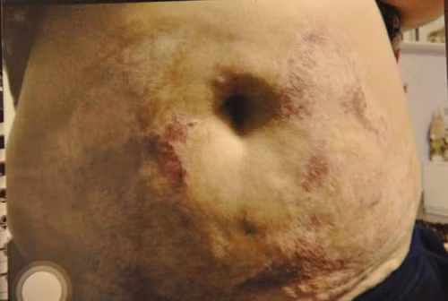 Nạn nhân H.N bị nhóm “bác sĩ” thẩm mỹ dỏm làm hư hết da vùng bụng.