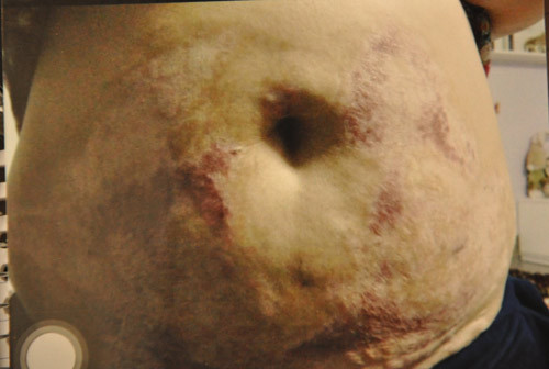 Nạn nhân H.N bị nhóm “bác sĩ” thẩm mỹ dỏm làm hư hết da vùng bụng. Nạn nhân H.N bị nhóm “bác sĩ” thẩm mỹ dỏm làm hư hết da vùng bụng.