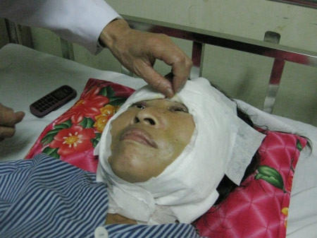 Một "cô gái hóa bà lão" sau khi được phẫu thuật căng da vùng mặt đã trẻ lại đến 90%