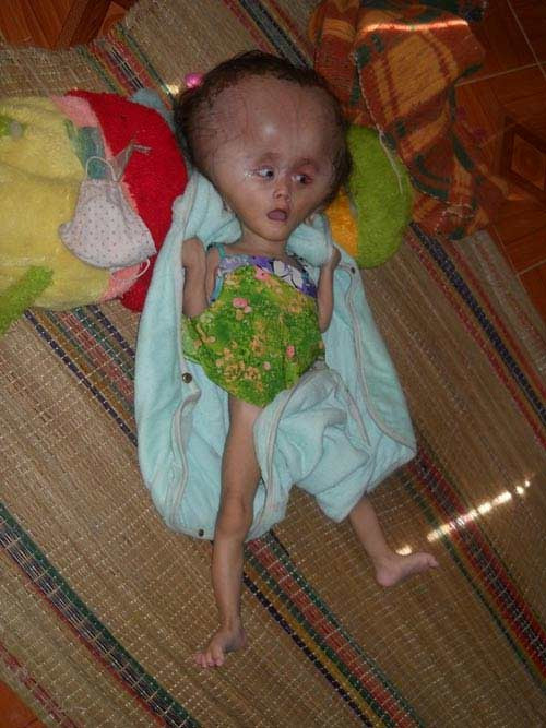 Bệnh lạ, bé 2 tuổi đầu to hơn nồi cơm điện ảnh 1 Bệnh lạ, bé 2 tuổi đầu to hơn nồi cơm điện, Tin tức trong ngày, Benh la, dau to, ma rung, dau co chat long, benh vien, bac si, Quang Nam, nganh y te, suc khoe, bao.