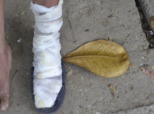 Bên chân bị bỏng của chị T. do cố chạy thoát khỏi căn nhà đang bốc cháy dữ dội