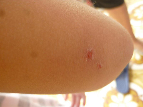 Lại phát hiện bọ xít hút máu người ở HN, Tin tức trong ngày, Bo xit hut mau nguoi, con trung la, ca the bo xit, bo xit phat tan, dot nguoi, dot tre em, ve sinh phong benh, tin tuc, suc khoe, bao.