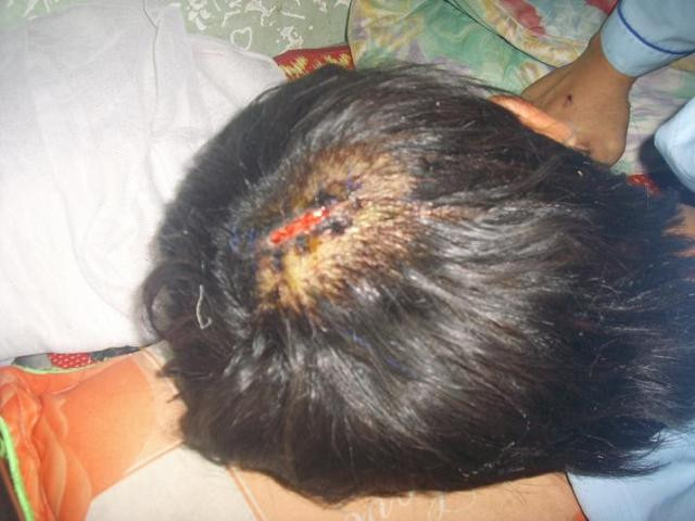 Vết thương trên đầu Linh do đối tượng Minh dùng mã tấu chém.