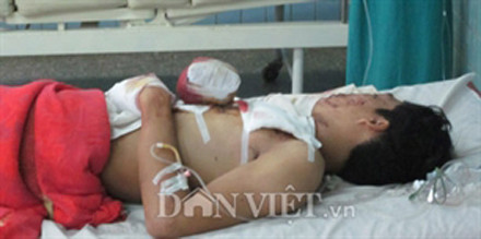 Đốt pháo, nổ nát hai bàn tay ảnh 1 Đốt pháo, nổ nát hai bàn tay ảnh 1