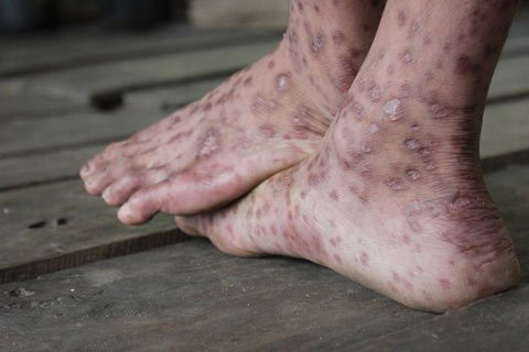 Bộ Y tế nhận định nguyên nhân gây "bệnh lạ", Tin tức trong ngày, nguyen nhan gay benh la, benh la quang ngai, benh la, bo y te, viem da, bao, tin tuc, tin hot, tin hay