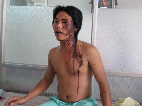 "Tạt axit phải xử tử hình!" ảnh 2 "Tạt axit phải xử tử hình!", An ninh - Hình sự, tat axit, vu an, tat, axit, noi dau axit, canh giac, bao