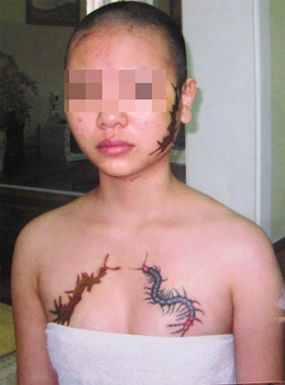 Trở về quê, cô gái đã xóa 2 trong 3 hình xăm. Ảnh: Hà Khoa Trở về quê, cô gái đã xóa 2 trong 3 hình xăm. Ảnh: Hà Khoa