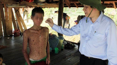 "Bệnh lạ" Quảng Ngãi: Nghi do gạo mốc, Tin tức trong ngày, benh la o quang ngai, benh la, day sung long ban tay ban chan, benh day sung, viem da long ban tay ban chan, benh viem da, benh la gay tu vong, bao, tin hay, tin hot, tin tuc