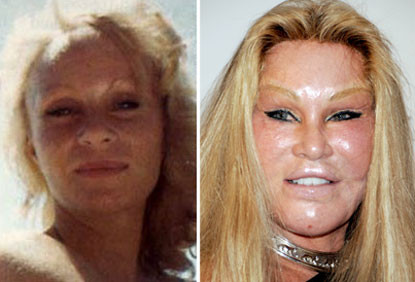 Nhà hoạt động xã hội Jocelyn Wildenstein cũng bị biến thành "quái nhân" vì công nghệ phẫu thuật thẩm mỹ. Cô đã chỉnh sửa mặt hàng trăm lần để trông giống mặt mèo. Nhà hoạt động xã hội Jocelyn Wildenstein cũng bị biến thành "quái nhân" vì công nghệ phẫu thuật thẩm mỹ. Cô đã chỉnh sửa mặt hàng trăm lần để trông giống mặt mèo.