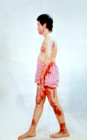 Bé Hiệp đang phải sống cùng những di chứng nặng nề. Bé Hiệp đang phải sống cùng những di chứng nặng nề.