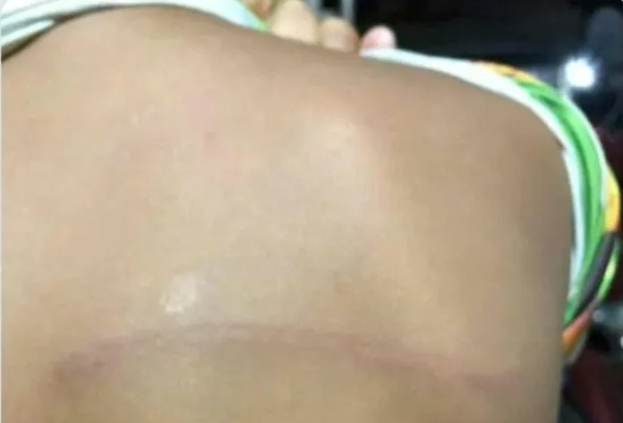 Hình ảnh vết hằn theo chiều ngang trên lưng học sinh. Ảnh: MXH danh hs.png