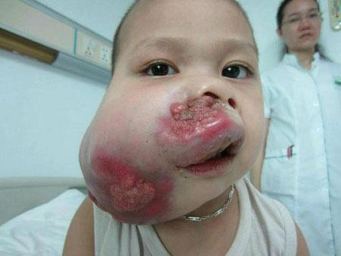 "Cuộc chiến đấu của mẹ và con với tử thần mang tên "ung thư"...." câu chuyện về cậu bé đáng thương đã nhận được sự chia sẻ cả vất chất lẫn tinh thần từ phía cư dân mạng. 5 865 lượt like (thích), 481 bình luận và 93 chia sẻ là những con số dành cho bức hình. "Cuộc chiến đấu của mẹ và con với tử thần mang tên "ung thư"...." câu chuyện về cậu bé đáng thương đã nhận được sự chia sẻ cả vất chất lẫn tinh thần từ phía cư dân mạng. 5 865 lượt like (thích), 481 bình luận và 93 chia sẻ là những con số dành cho bức hình.