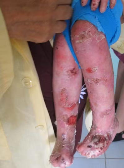 Ghép tủy cứu bé 4 tuổi bị "lột da ếch" ảnh 1