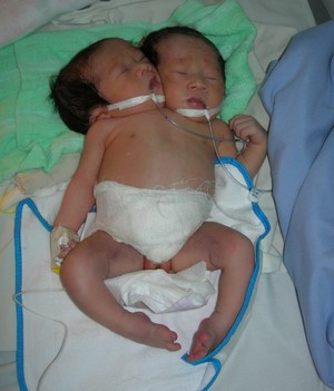 Bé gái này thực chất là hai cơ thể dính nhau, không hoàn chỉnh. Ảnh: Thiên Phước. Bé gái này thực chất là hai cơ thể dính nhau, không hoàn chỉnh. Ảnh: Thiên Phước.