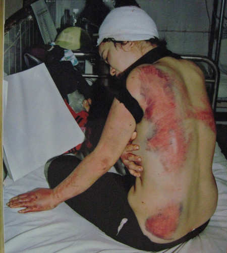 Chị Ánh với các vết thương do bị chồng hành hung. Chị Ánh với các vết thương do bị chồng hành hung.