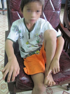 Bị bố bạo hành, cắt gân chân, hai em bé bỏ nhà ra đi ảnh 2 Hai em nhỏ bỏ nhà ra đi vì cha bạo hành, Tin tức trong ngày, bo bao hanh con, bao hanh, cha de, bo nha, hai chi em, trung tam bao tro xa hoi, bao, tin tuc, tin hot, tin hay, vn