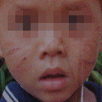 Cháu Tiến với những vết sẹo chi chít