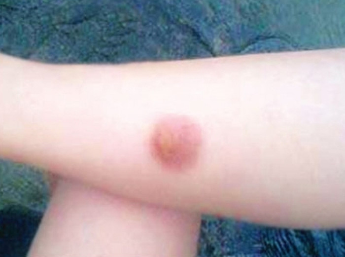 7. Chữa bỏng nhẹ (chưa bị bong da): Củ kiệu bỏ vỏ ngoài, giã nát, trộn mật đắp vào chỗ bị bỏng. Ngày đắp 3 lần, mỗi lần đắp cần vệ sinh sạch sẽ nơi bị bỏng. 7. Chữa bỏng nhẹ (chưa bị bong da): Củ kiệu bỏ vỏ ngoài, giã nát, trộn mật đắp vào chỗ bị bỏng. Ngày đắp 3 lần, mỗi lần đắp cần vệ sinh sạch sẽ nơi bị bỏng.