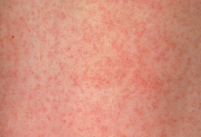 13. Rubella (sởi Đức): Rubella, hay còn gọi là sởi Đức, bệnh do một loài virus gây ra, nhưng không gây vấn đề nghiêm trọng đến sức khỏe. Các triệu chứng thường gặp là sốt nhẹ và phát ban lây lan từ mặt đến các bộ phận khác của cơ thể. 13. Rubella (sởi Đức): Rubella, hay còn gọi là sởi Đức, bệnh do một loài virus gây ra, nhưng không gây vấn đề nghiêm trọng đến sức khỏe. Các triệu chứng thường gặp là sốt nhẹ và phát ban lây lan từ mặt đến các bộ phận khác của cơ thể.