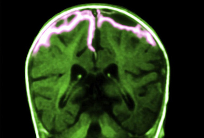 15. Viêm màng não: Viêm màng não là tình trạng viêm hoặc nhiễm trùng các mô xung quanh não và tủy sống. Ở trẻ nhỏ bệnh thường có các triệu chứng giống như cúm. Khi bị viêm mang não mà không được điều trị nhanh chóng thì sẽ để lại hậu quả nghiêm trong. 15. Viêm màng não: Viêm màng não là tình trạng viêm hoặc nhiễm trùng các mô xung quanh não và tủy sống. Ở trẻ nhỏ bệnh thường có các triệu chứng giống như cúm. Khi bị viêm mang não mà không được điều trị nhanh chóng thì sẽ để lại hậu quả nghiêm trong.