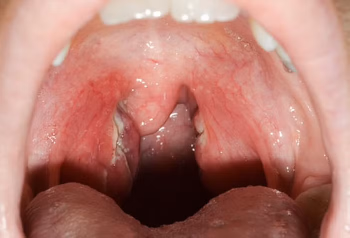 16. Viêm họng: Những dấu hiệu bao gồm đau họng kéo dài hơn một tuần, đau đớn hoặc khó nuốt, chảy nước dãi quá mức, phát ban, có mủ ở mặt sau của cổ họng … Viêm họng được điều trị bằng kháng sinh.