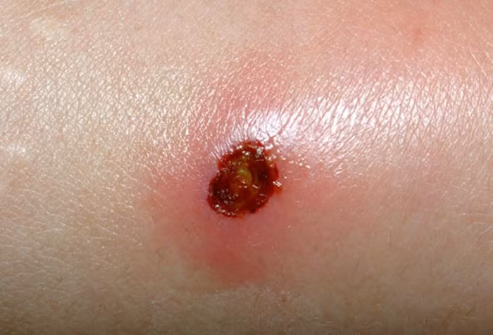 19. Nhiễm trùng da: Bệnh do loại vi khuẩn có tên là MRSA gây nên. Bệnh nhiễm trùng này thường xuất hiện ở các vết loét hoặc bóng nước.