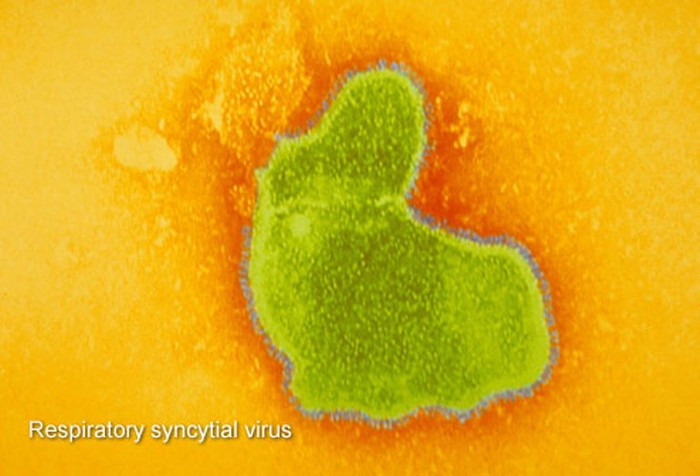 1.Bệnh RSV: Đây là từ viết tắt của virus tế bào hô hấp, loại virus này cũng chính là nguyên nhân hàng đầu gây nên các bệnh về viêm tiểu phế quản (viêm đường hô hấp nhỏ) và viêm phổi ở trẻ sơ sinh. Triệu chứng của căn bệnh này giống như cúm, bao gồm sốt, chảy nước mũi, và ho. Tuy nhiên, căn bệnh này sẽ giảm dần theo sự phát triển của cơ thể. 1.Bệnh RSV: Đây là từ viết tắt của virus tế bào hô hấp, loại virus này cũng chính là nguyên nhân hàng đầu gây nên các bệnh về viêm tiểu phế quản (viêm đường hô hấp nhỏ) và viêm phổi ở trẻ sơ sinh. Triệu chứng của căn bệnh này giống như cúm, bao gồm sốt, chảy nước mũi, và ho. Tuy nhiên, căn bệnh này sẽ giảm dần theo sự phát triển của cơ thể.